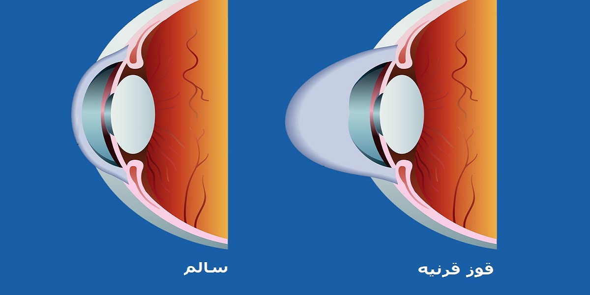 ارائه راهکارهای تشخیص زودهنگام بیماری قوزقرنیه بر پایه یادگیری ماشین